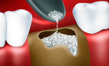 Костная пластика лечение зубов Мытищи