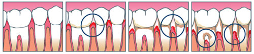 Лечение десен Мытищи стоматология